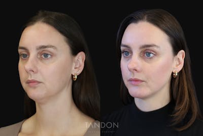 Chin Augmentation Before & After Gallery - Patient 147726 - Image 1