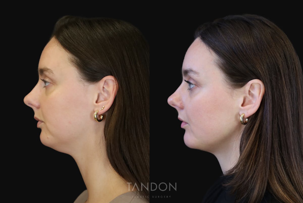 Neck Liposuction Before & After Gallery - Patient 320831 - Image 1