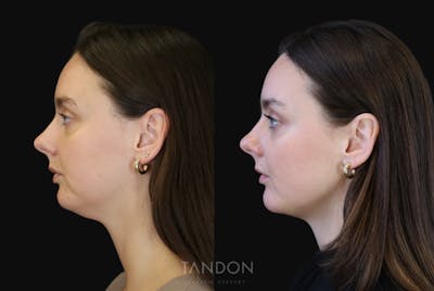 Neck Liposuction Before & After Gallery - Patient 320831 - Image 1