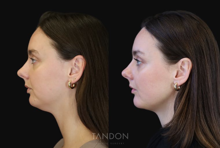 Chin Augmentation Before & After Gallery - Patient 147726 - Image 2