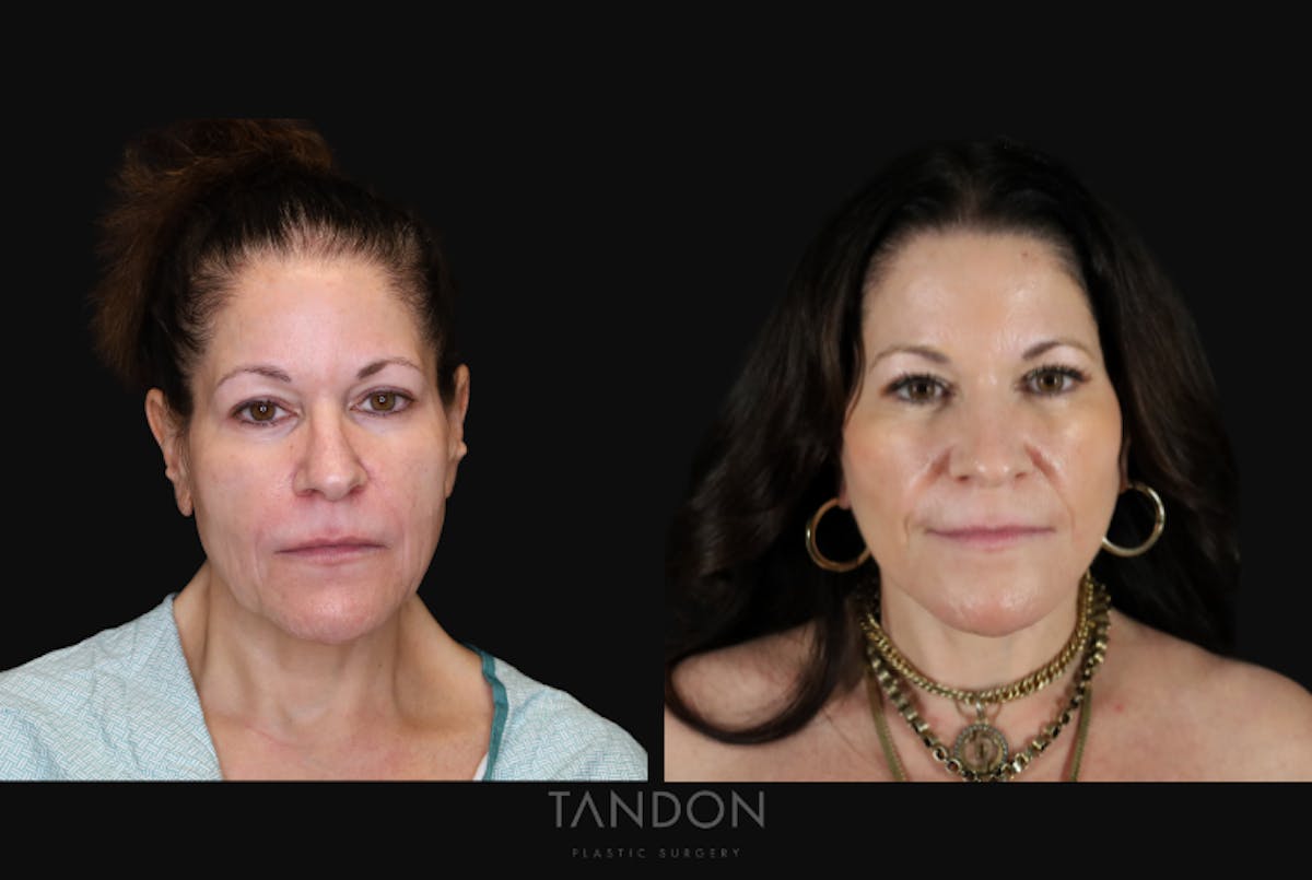 CO2 Laser Resurfacing Before & After Gallery - Patient 947022 - Image 1