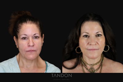 Neck Lift Before & After Gallery - Patient 188643 - Image 1