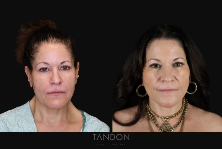 CO2 Laser Resurfacing Before & After Gallery - Patient 947022 - Image 1