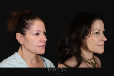 Deep Plane Facelift Before & After Gallery - Patient 297879 - Image 1