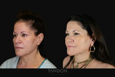 Deep Plane Facelift Before & After Gallery - Patient 297879 - Image 1