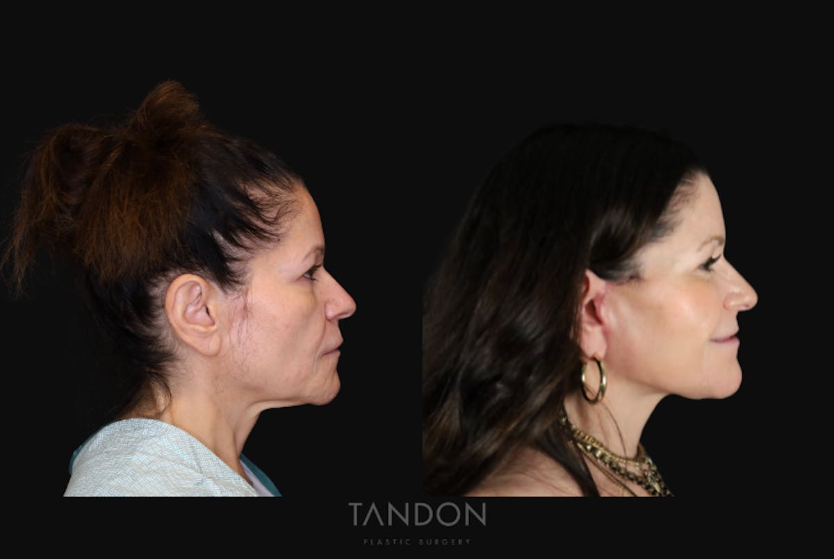 CO2 Laser Resurfacing Before & After Gallery - Patient 947022 - Image 3