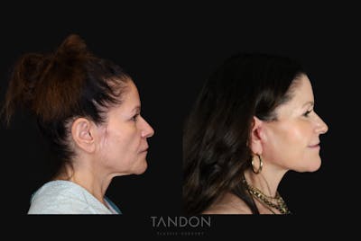 Neck Lift Before & After Gallery - Patient 188643 - Image 1