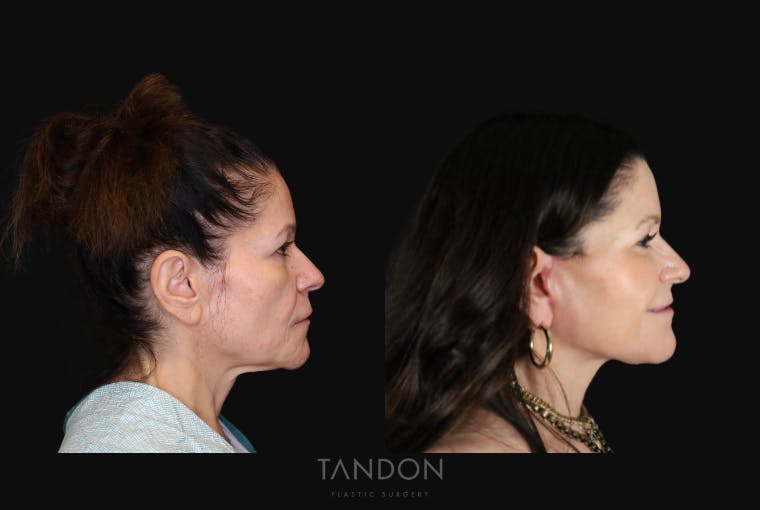CO2 Laser Resurfacing Before & After Gallery - Patient 947022 - Image 3