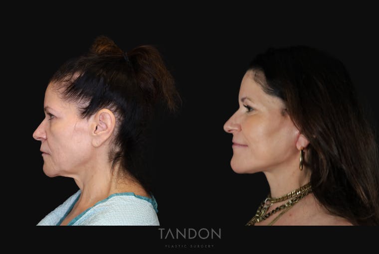 CO2 Laser Resurfacing Before & After Gallery - Patient 947022 - Image 4