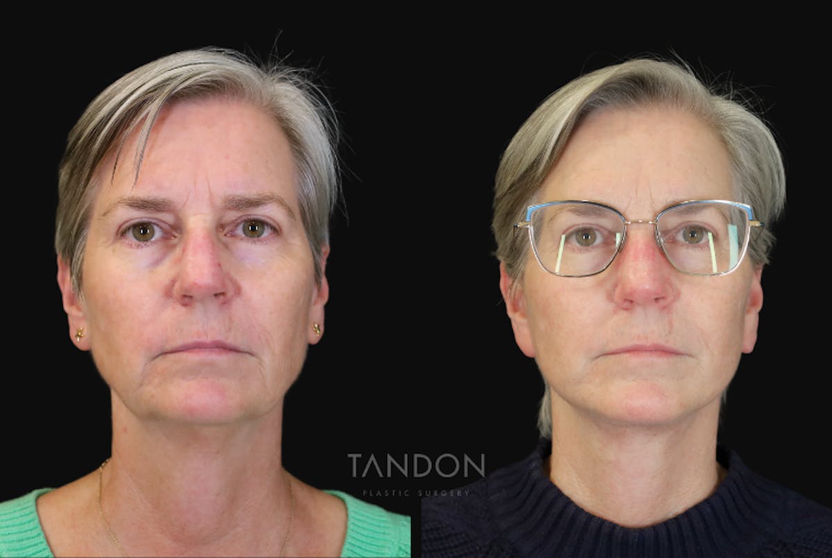 Neck Lift Before & After Gallery - Patient 368690 - Image 1
