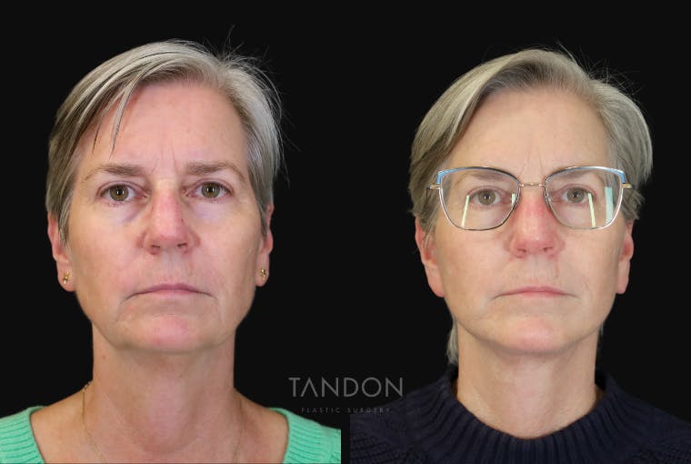 Facelift Before & After Gallery - Patient 412764 - Image 1