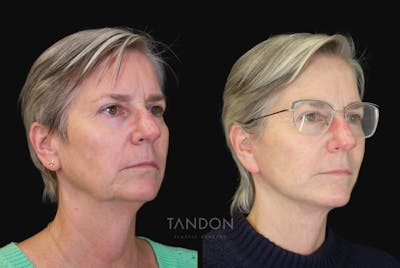 Facelift Before & After Gallery - Patient 412764 - Image 1