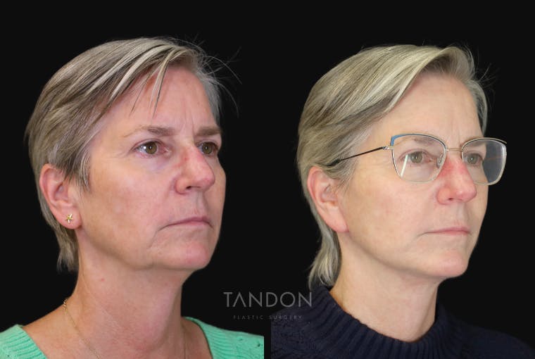 Facelift Before & After Gallery - Patient 412764 - Image 3