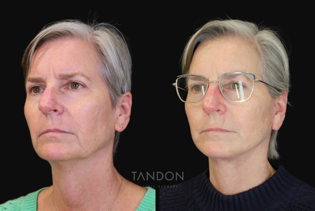 Neck Lift Before & After Gallery - Patient 368690 - Image 4