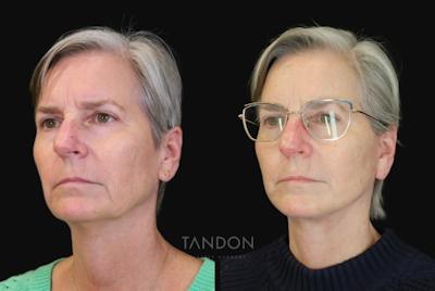 Facelift Before & After Gallery - Patient 412764 - Image 1
