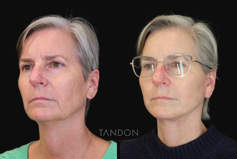 Facelift Before & After Gallery - Patient 412764 - Image 4