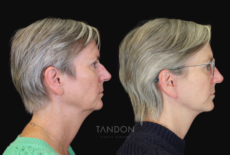 Facelift Before & After Gallery - Patient 412764 - Image 2