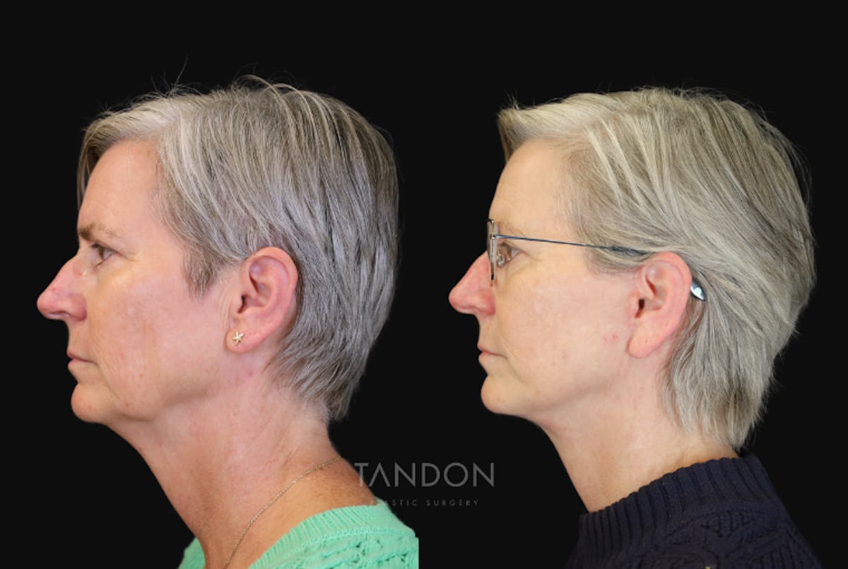 Neck Lift Before & After Gallery - Patient 368690 - Image 5