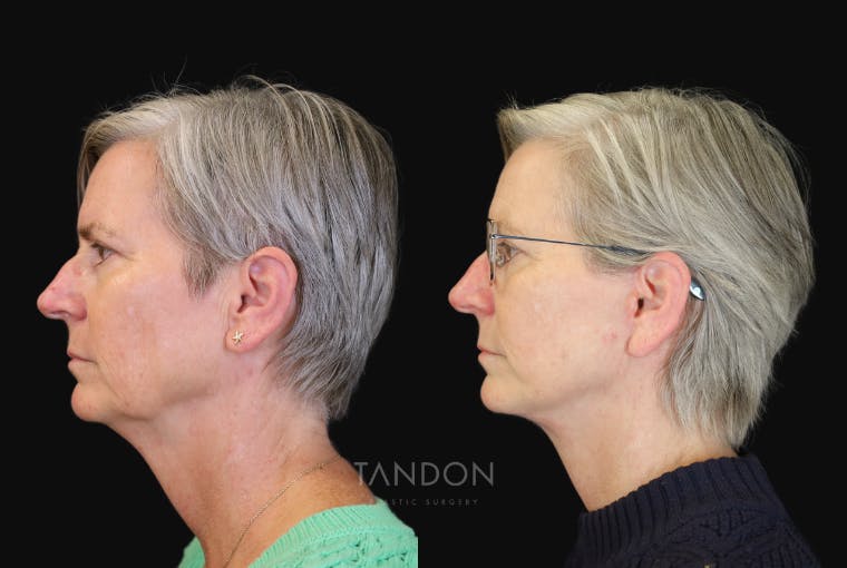 Facelift Before & After Gallery - Patient 412764 - Image 5
