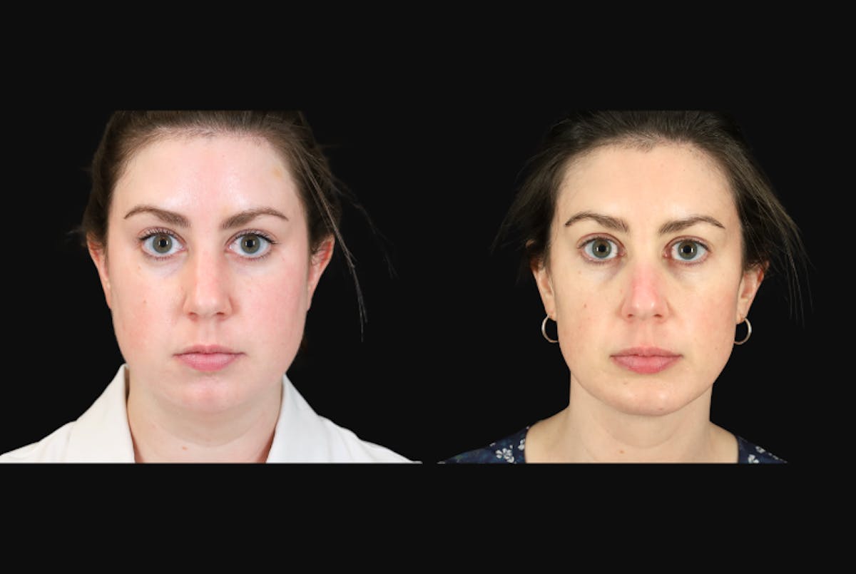 Neck Lift Before & After Gallery - Patient 302284 - Image 1