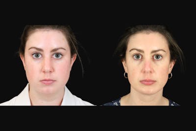 Neck Lift Before & After Gallery - Patient 302284 - Image 1
