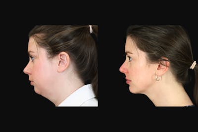 Neck Lift Before & After Gallery - Patient 302284 - Image 1