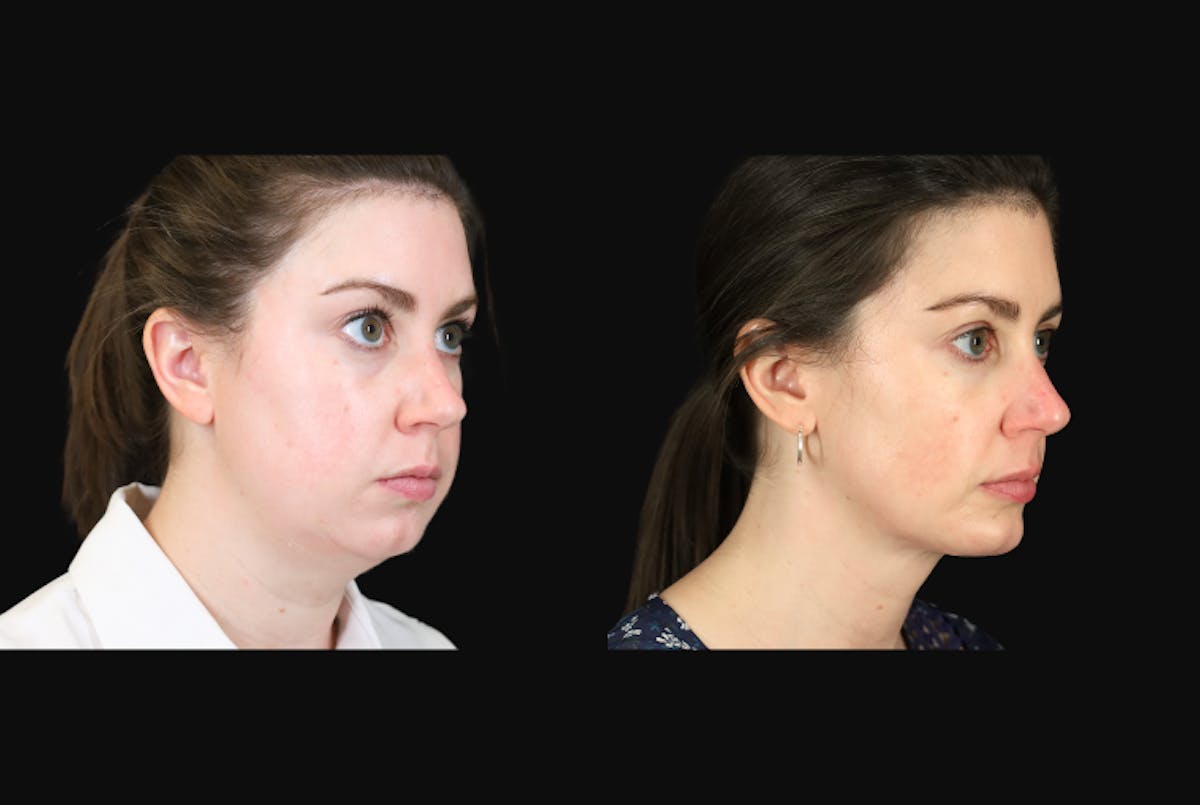 Neck Lift Before & After Gallery - Patient 302284 - Image 4
