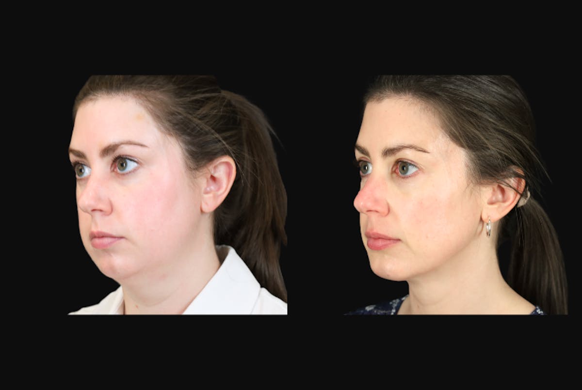 Neck Lift Before & After Gallery - Patient 302284 - Image 3