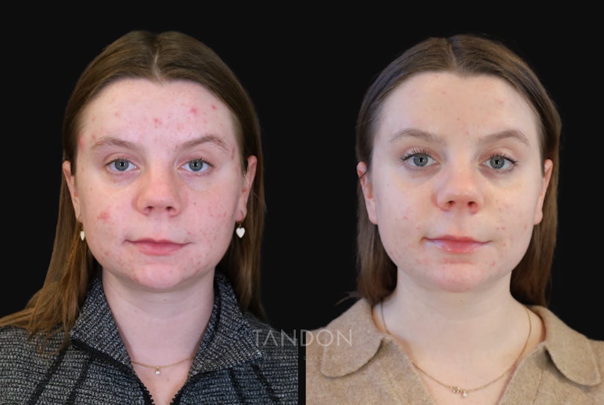 Neck Liposuction Before & After Gallery - Patient 385413 - Image 3