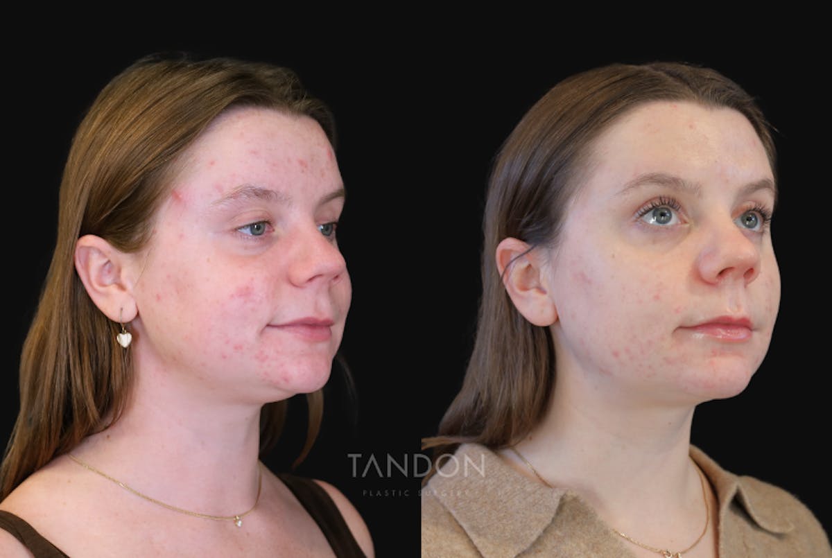 Neck Liposuction Before & After Gallery - Patient 385413 - Image 4