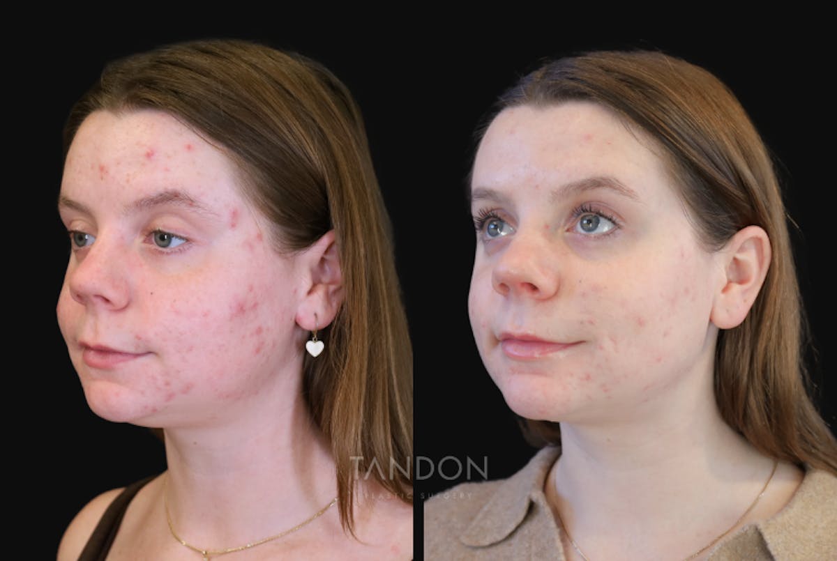 Neck Liposuction Before & After Gallery - Patient 385413 - Image 2