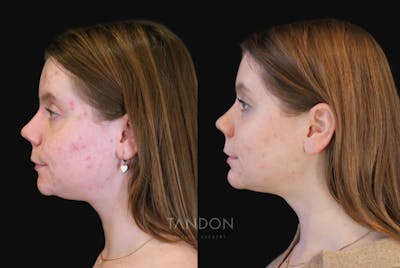 Neck Liposuction Before & After Gallery - Patient 385413 - Image 1