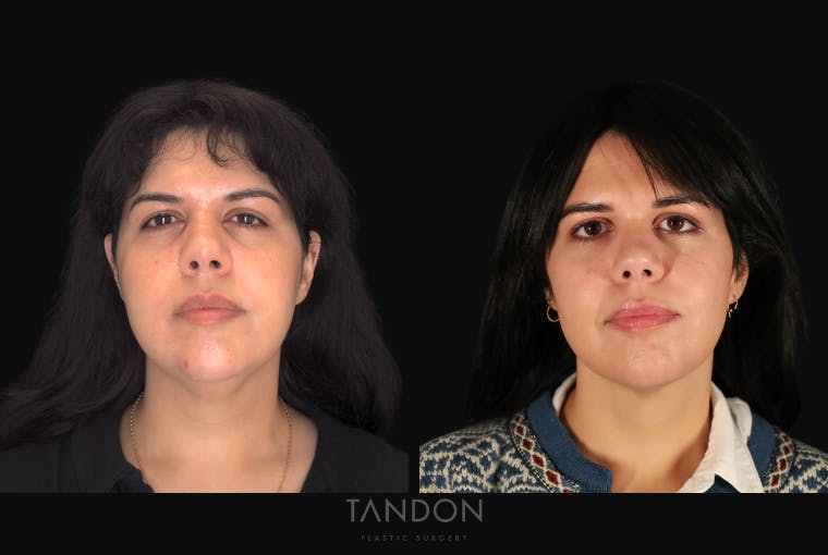 Neck Liposuction Before & After Gallery - Patient 187259 - Image 3