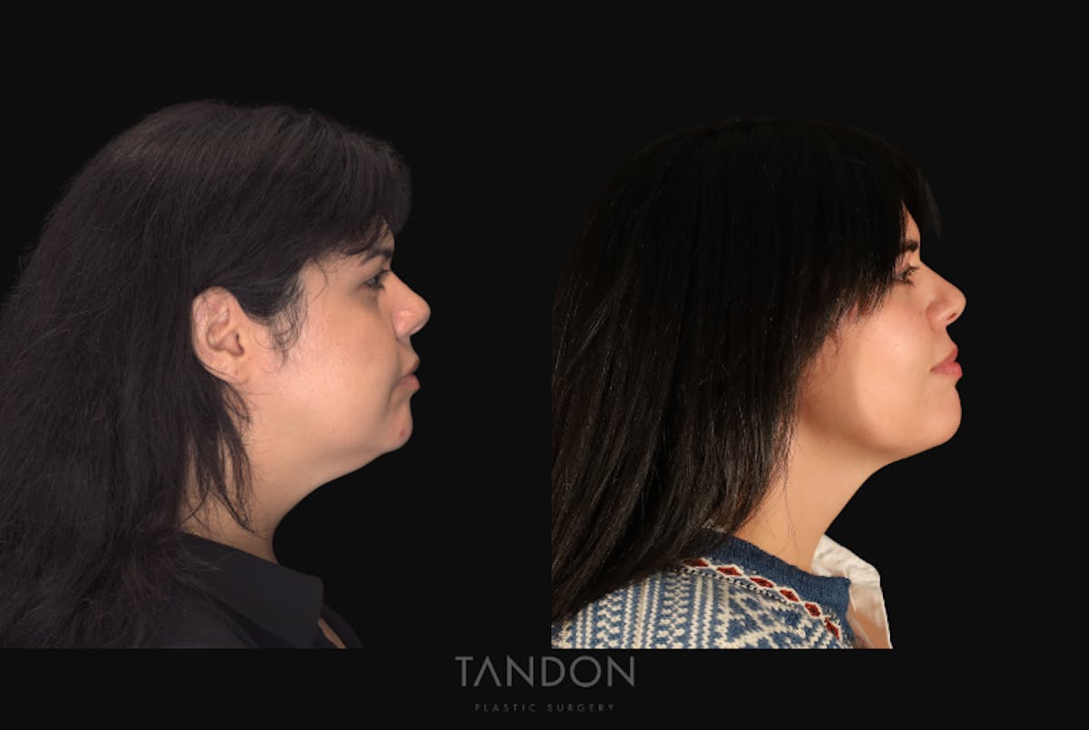 Neck Liposuction Before & After Gallery - Patient 187259 - Image 1