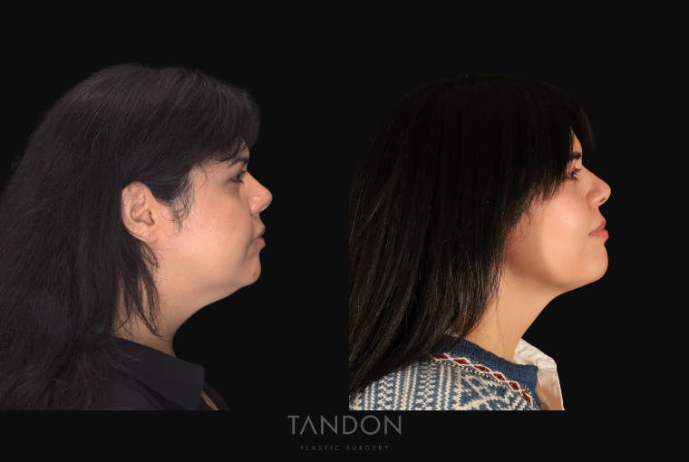 Neck Liposuction Before & After Gallery - Patient 187259 - Image 1