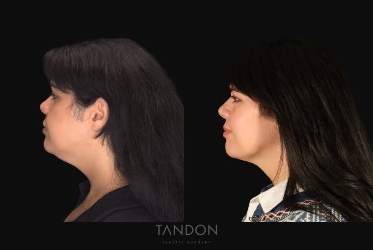 Neck Liposuction Before & After Gallery - Patient 187259 - Image 5
