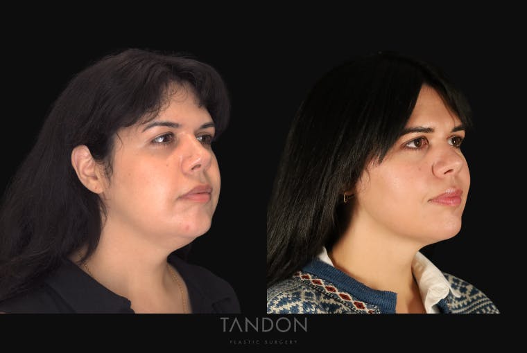 Neck Liposuction Before & After Gallery - Patient 187259 - Image 2