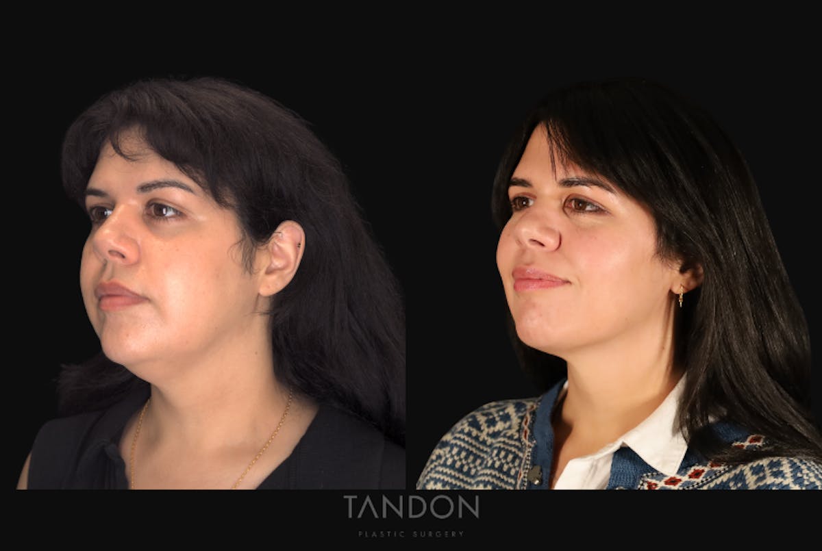 Neck Liposuction Before & After Gallery - Patient 187259 - Image 4