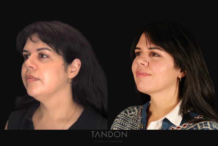 Neck Liposuction Before & After Gallery - Patient 187259 - Image 4