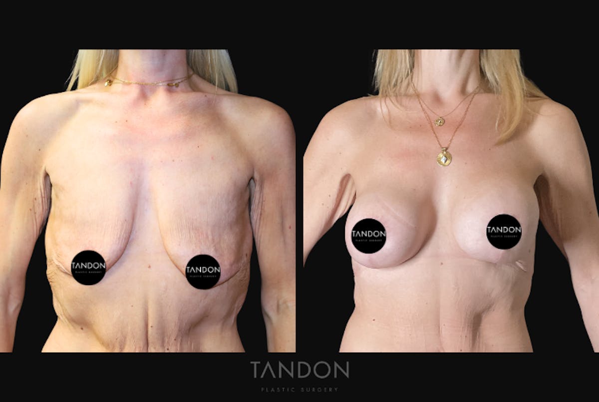 Breast Lift Before & After Gallery - Patient 510162 - Image 1