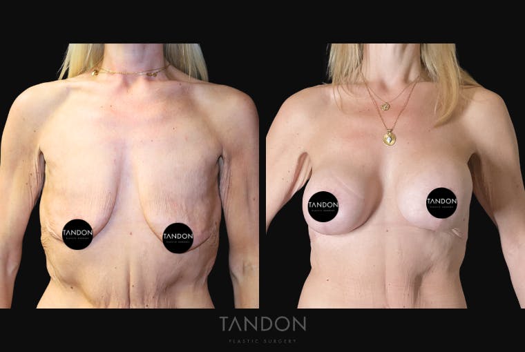 Breast Lift Before & After Gallery - Patient 510162 - Image 1