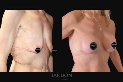 Breast Lift Before & After Gallery - Patient 510162 - Image 2