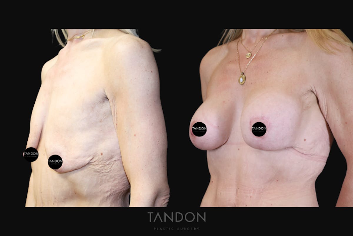 Breast Lift Before & After Gallery - Patient 510162 - Image 4
