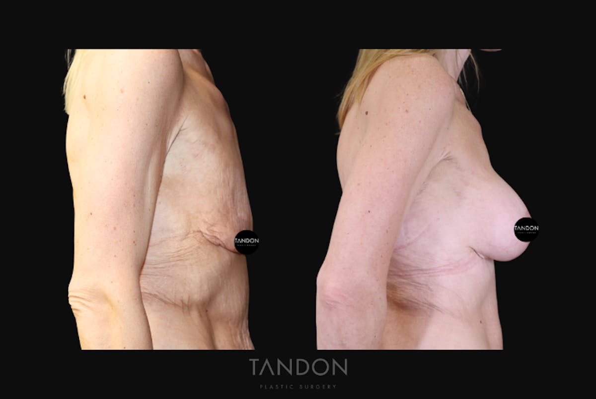 Breast Lift Before & After Gallery - Patient 510162 - Image 3
