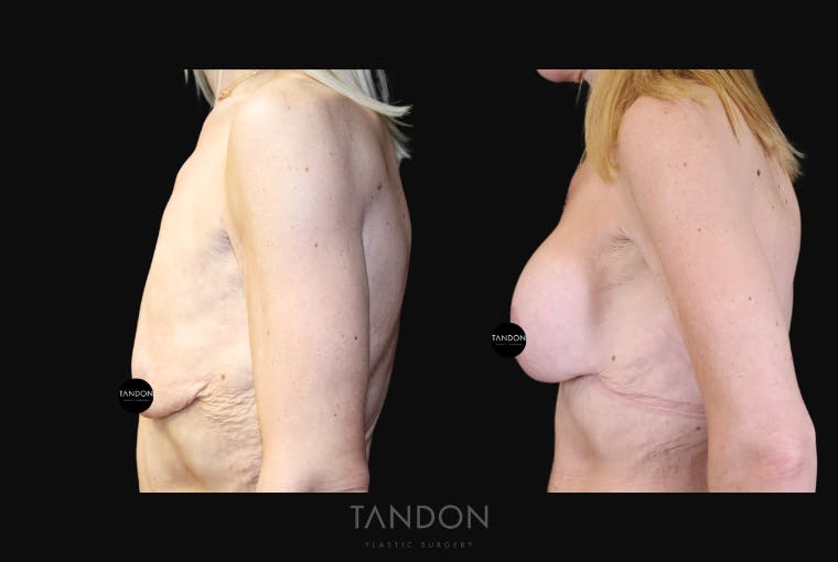 Breast Lift Before & After Gallery - Patient 510162 - Image 5
