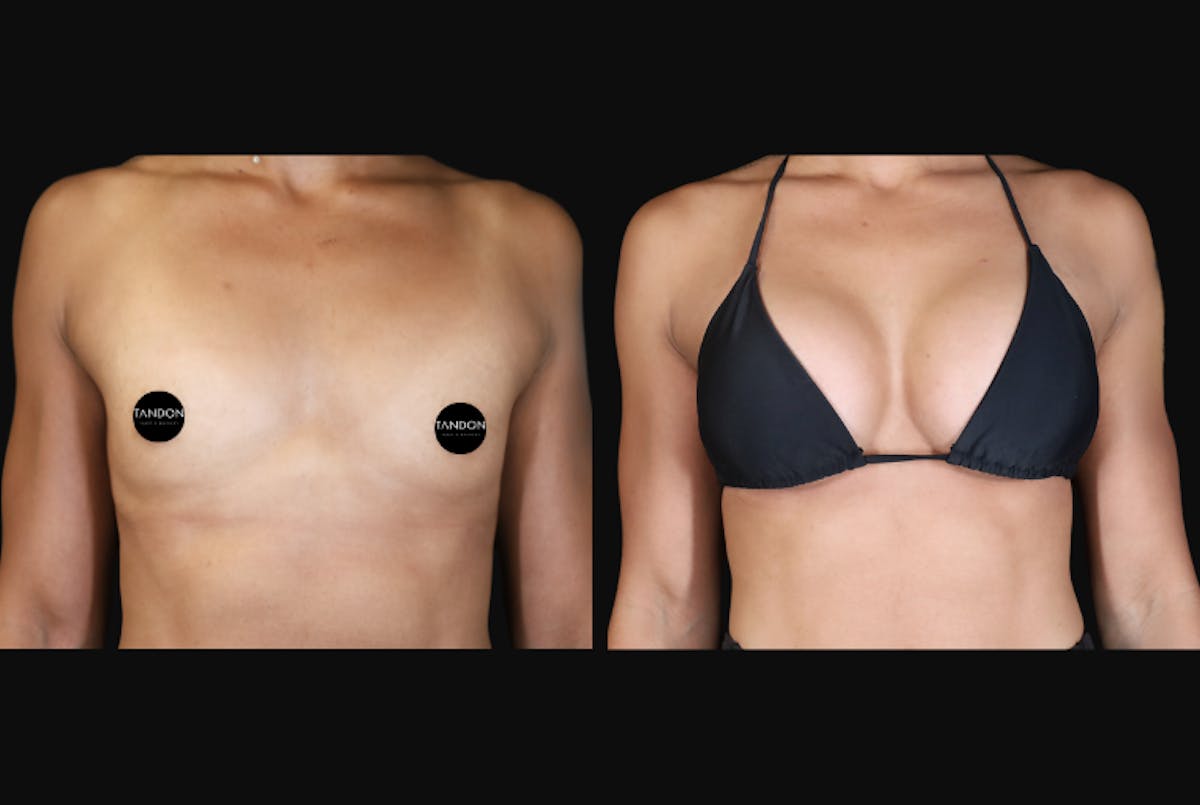 Breast Augmentation Before & After Gallery - Patient 242509 - Image 2