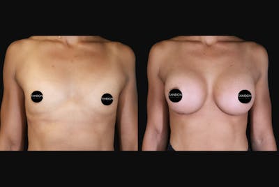 Breast Augmentation Before & After Gallery - Patient 242509 - Image 1