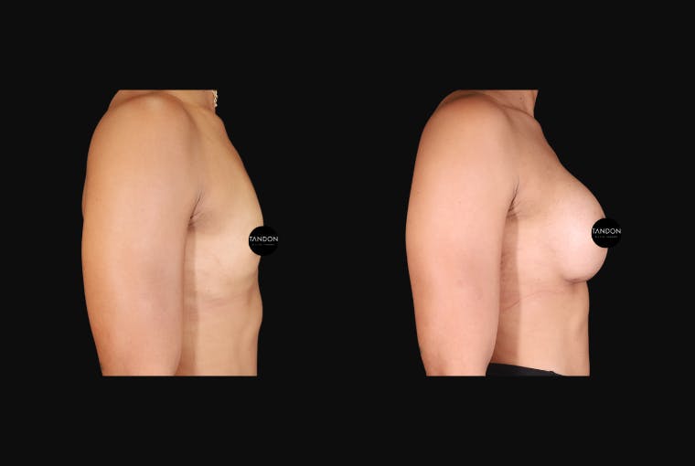 Breast Augmentation Before & After Gallery - Patient 242509 - Image 8