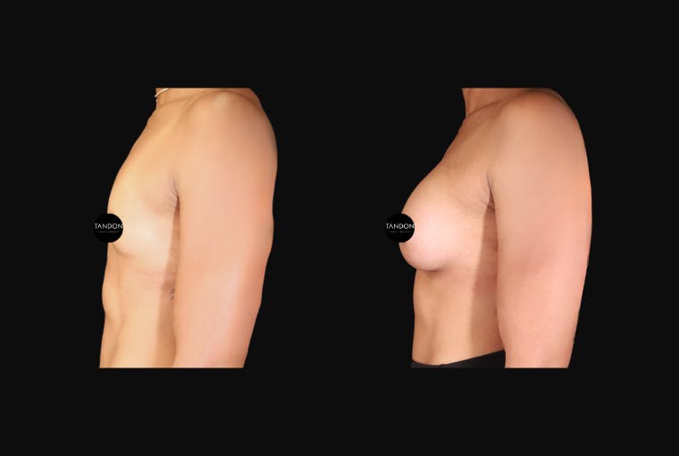 Breast Augmentation Before & After Gallery - Patient 242509 - Image 3