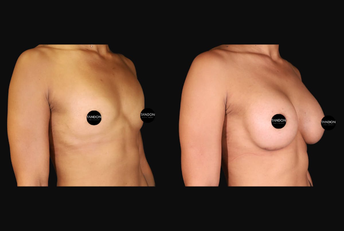 Breast Augmentation Before & After Gallery - Patient 242509 - Image 7